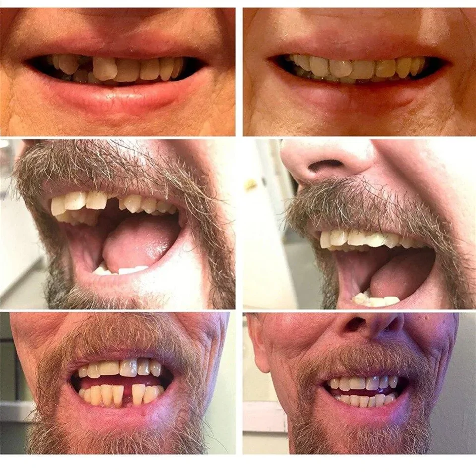 Instant smile - fogsor javító készlet vészhelyzet esetére - ideiglenes fogpótlás készítő