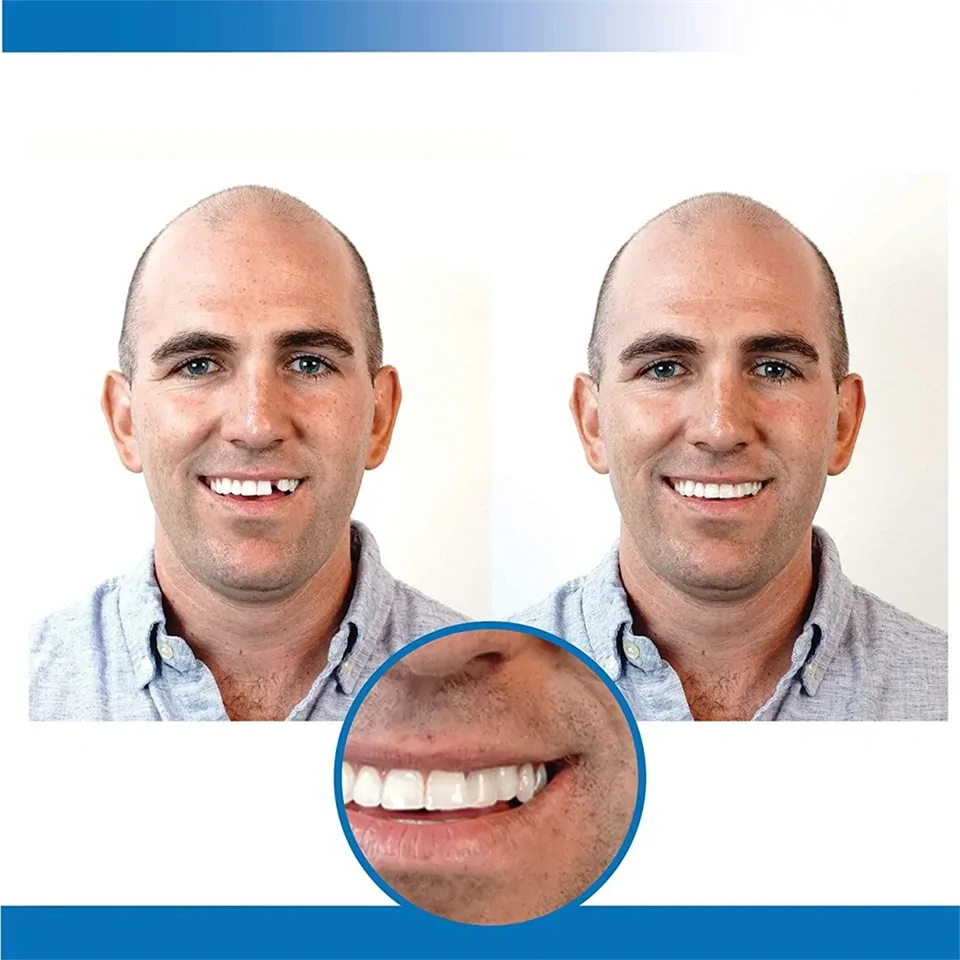 Instant smile - fogsor javító készlet vészhelyzet esetére - ideiglenes fogpótlás készítő
