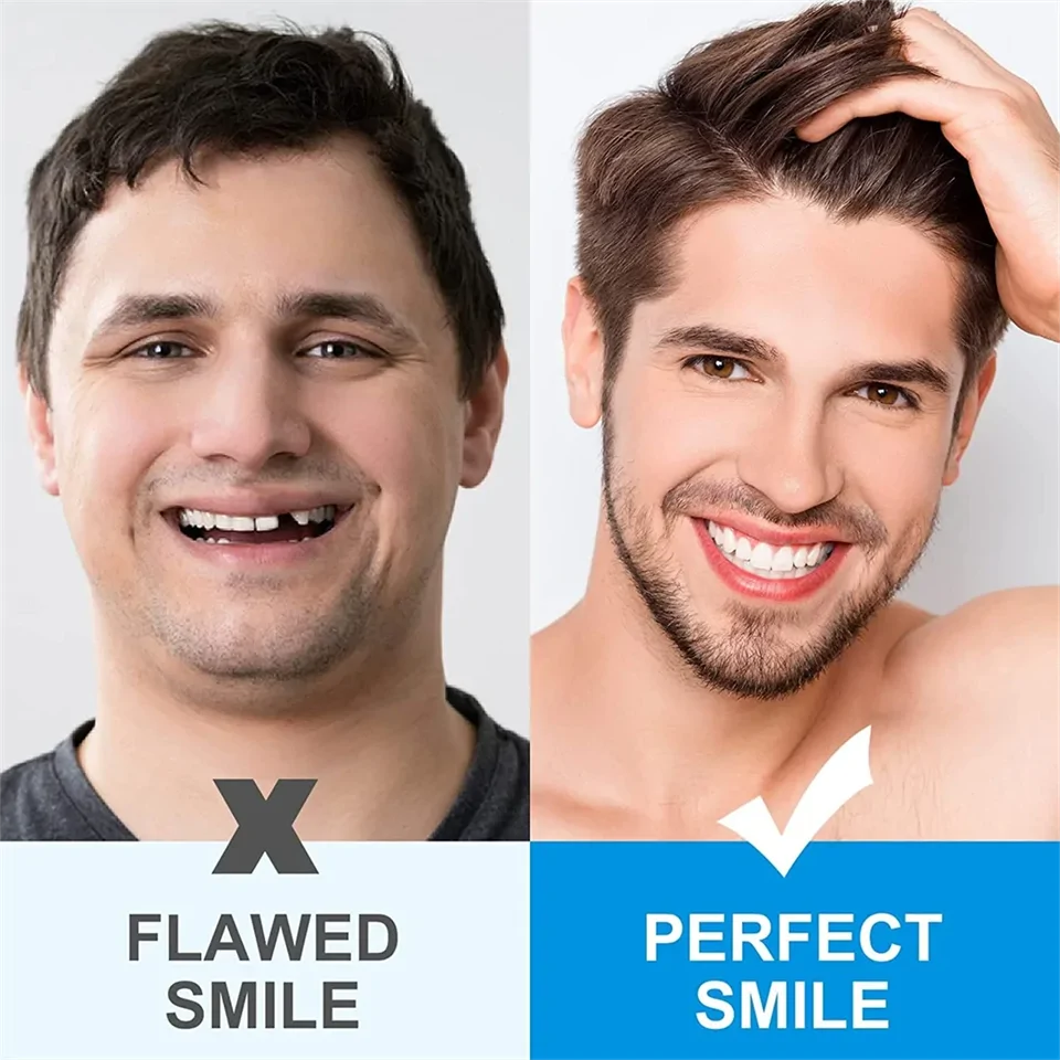 Instant smile - fogsor javító készlet vészhelyzet esetére - ideiglenes fogpótlás készítő