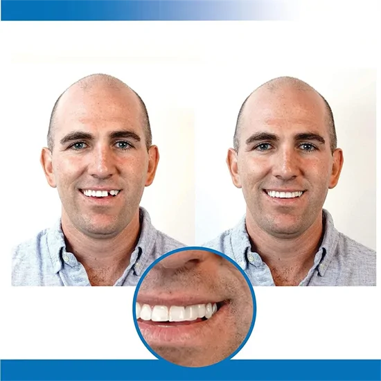Instant smile - fogsor javító készlet vészhelyzet esetére - ideiglenes fogpótlás készítő